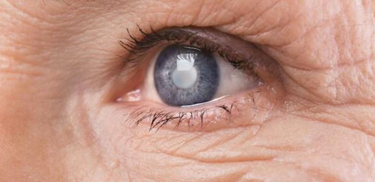 “Katarakt-her-yaşta,-hatta-doğumla-bile-olabilir”