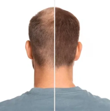 KAPAK Saç Dökülmesi