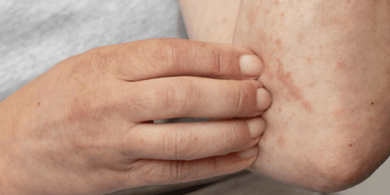 Uyuz nasıl tespit edilir? Uyuz belirtileri nelerdir?