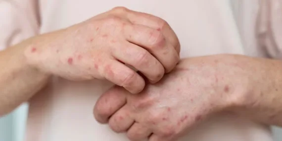 Uyuz, cinsel partnere ve ev halkına daha kolay bulaşıyor