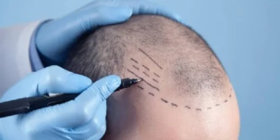 Saç ektirecekler dikkat! Bu şartlara bakmadan klinik seçmeyin