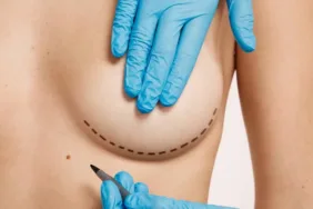 meme dikleştirme ameliyatı