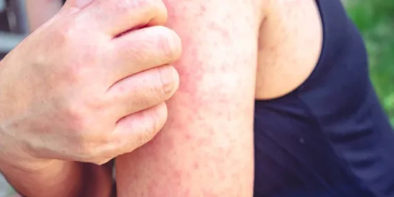 Kızamık belirtileri nedir? Nasıl geçer?