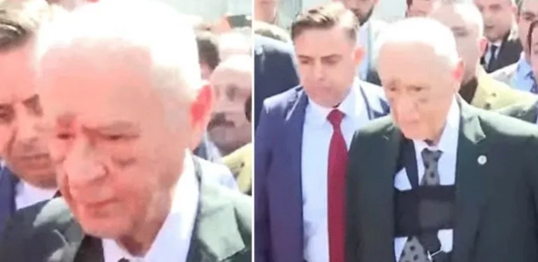 Devlet Bahçeli'nin oy kullanma görüntüleri Yüzündeki morluklar merak konusu oldu!