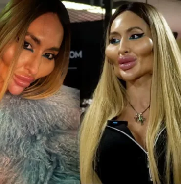 Dünyanın en büyük elmacık kemiklerine sahip... Anastasia Pokreshchuk estetiklerini sıraladı