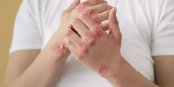 Uyuz hastalığı ilk bu belirtiyi veriyor! Özellikle o aylara dikkat…