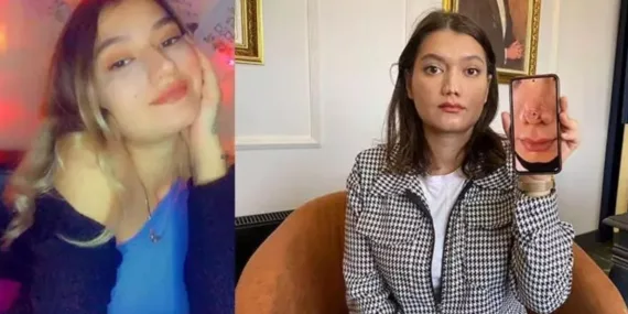 Ameliyatta burun estetiği başarısızlığı: 1 Milyon liralık tazminat davası