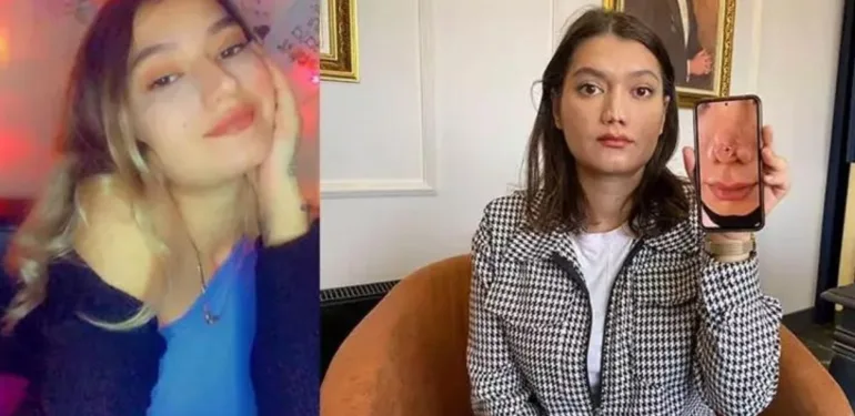 Ameliyatta burun estetiği başarısızlığı 1 Milyon liralık tazminat davası