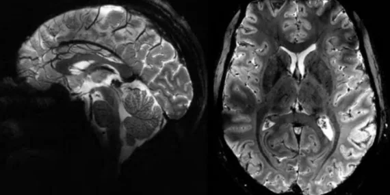 Fransa’da yeni MRI teknolojisi: En net insan beyni görüntüsü