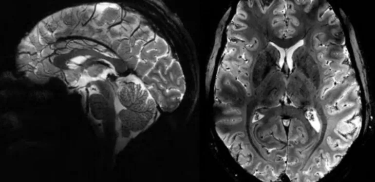 Fransa'da yeni MRI teknolojisi En net insan beyni görüntüsü