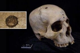 Antik Mısır'da kanser ameliyatı 4.500 yıllık gizem çözüldü!