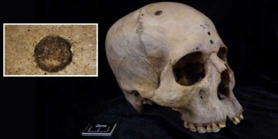 Antik Mısır’da kanser ameliyatı: 4.500 yıllık gizem çözüldü!