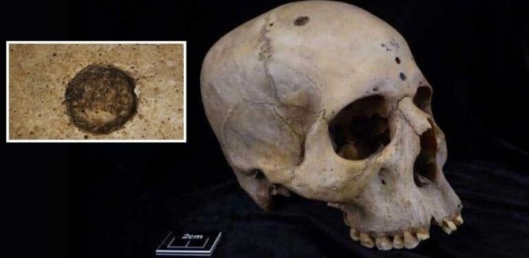 Antik Mısır’da kanser ameliyatı: 4.500 yıllık gizem çözüldü!