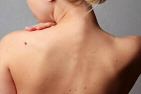 Türkiye'de 28 ilde cilt kanserine karşı ücretsiz ben taraması yapılacak