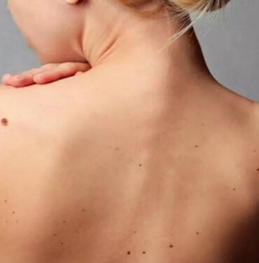 Türkiye'de 28 ilde cilt kanserine karşı ücretsiz ben taraması yapılacak