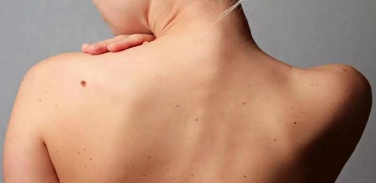 Türkiye'de 28 ilde cilt kanserine karşı ücretsiz ben taraması yapılacak