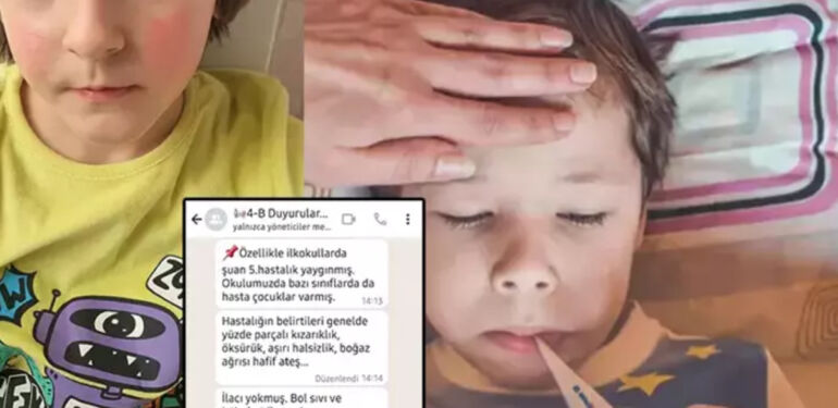 Uzmanlar uyardı! Baharın çocuklara sürprizi Beşinci hastalık