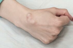 El bileğinizdeki ağrının nedeni 'ganglion kisti' olabilir