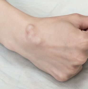 El bileğinizdeki ağrının nedeni 'ganglion kisti' olabilir