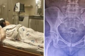 Skandal olay Doğumda vücudunda unutulan gazlı bez 10 ay sonra fark edildi!