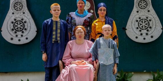 Toplumsal ayrımcılıkla mücadele eden Afrikalı albinolar