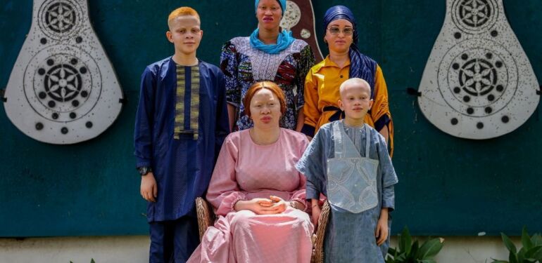 Toplumsal ayrımcılıkla mücadele eden Afrikalı albinolar