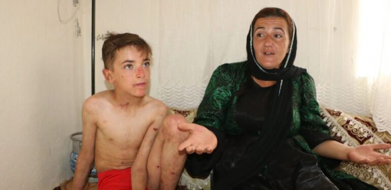 10 yaşındaki Amar Yaşar 'deri hastalığından' kurtulmak istiyor 'Vücudum yaralardan sürekli kanıyor'