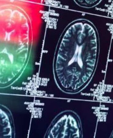 AB, 'tarihi' Alzheimer ilacına ruhsat vermedi_ 'Faydası, riskleri görmezden gelecek kadar değil'
