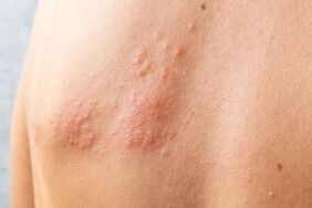 Bakkal poşeti bile taşıtmayan hastalık Dermografik ürtiker