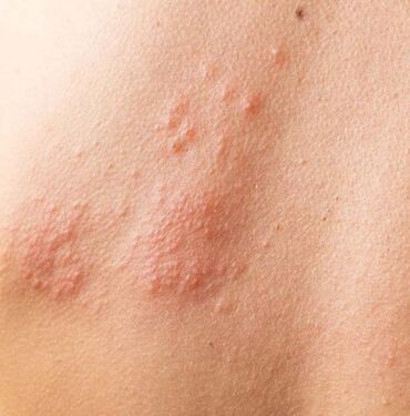 Bakkal poşeti bile taşıtmayan hastalık Dermografik ürtiker