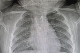 Çengelli iğne yutan 10 aylık bebek zamanında müdahaleyle kurtuldu