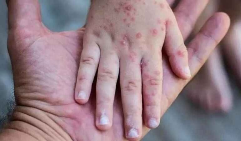 Kongo Demokratik Cumhuriyeti’nde M çiçeği salgını yayılıyor