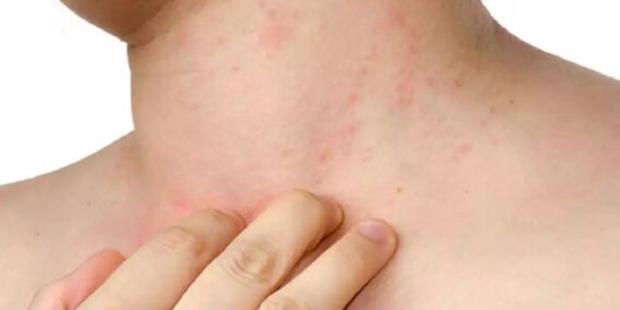 Uzmanlar uyarıyor: ‘Son 10 yılın alerji salgını: Besin alerjileri, giderek artıyor’