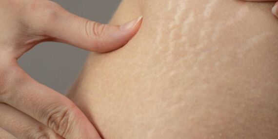 Cilt lekeleri ve çatlaklarından kurtulmanın yolları nelerdir?