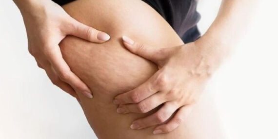 Selülitlerden kurtulmanın doğal yolları: Mutfakta bulunan sıkı bacakların sırrı…