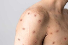 Acil durum uyarısı Maymun çiçek virüsü nedir