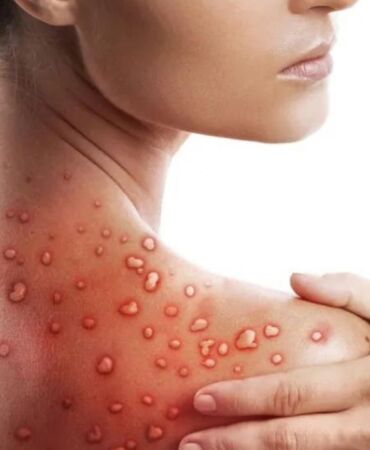 DMM açıkladı Maymun çiçeği virüsü Türkiye'de var mı