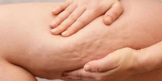 Sık görülen ama az bilinen: Lipödem nedir ve nasıl tedavi edilir?