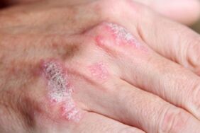 Uzman diyetisyen açıkladı Sedef hastalığında beslenmenin önemi