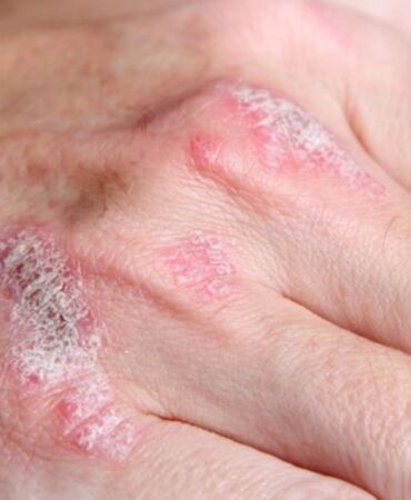 Uzman diyetisyen açıkladı Sedef hastalığında beslenmenin önemi