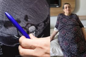 Yumurtalıklarındaki 23 kiloluk kitle operasyonla çıkarıldı Doktorlar da şaşırdı