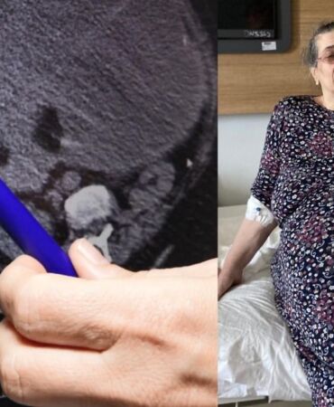 Yumurtalıklarındaki 23 kiloluk kitle operasyonla çıkarıldı Doktorlar da şaşırdı