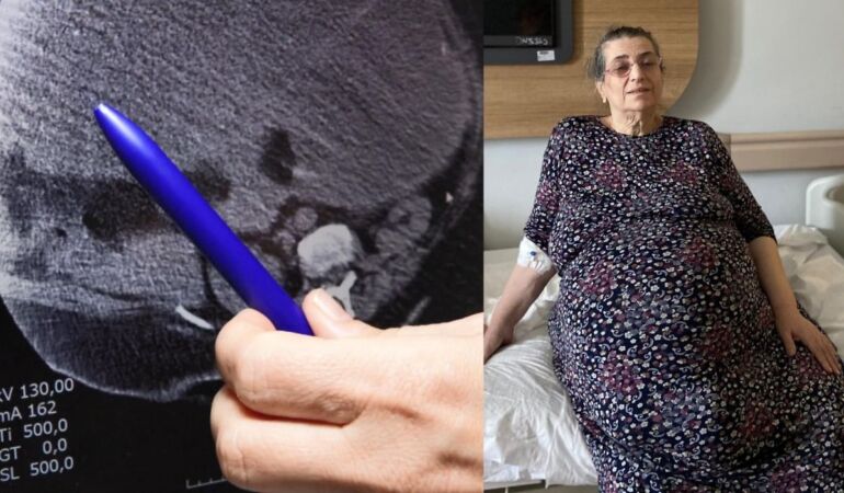 Yumurtalıklarındaki 23 kiloluk kitle operasyonla çıkarıldı: Doktorlar da şaşırdı