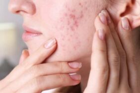 akne