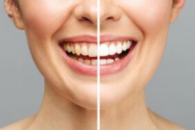 beyaz dişler