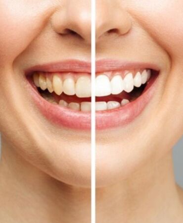 beyaz dişler