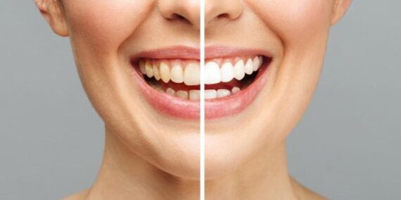 Sararmış dişlerin sebebi bu yaygın hata! uzmanlar uyardı