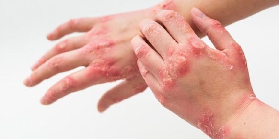 Uzmanı açıkladı: Egzaması olanlar yaz aylarında nelere dikkat etmeli?