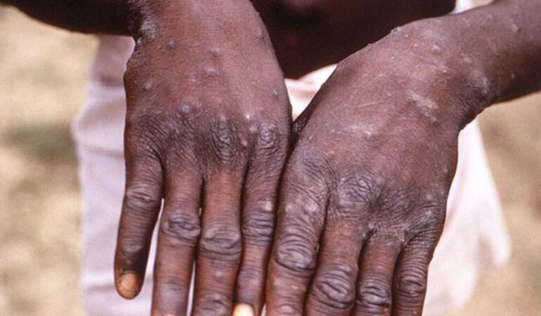 maymun çiceği