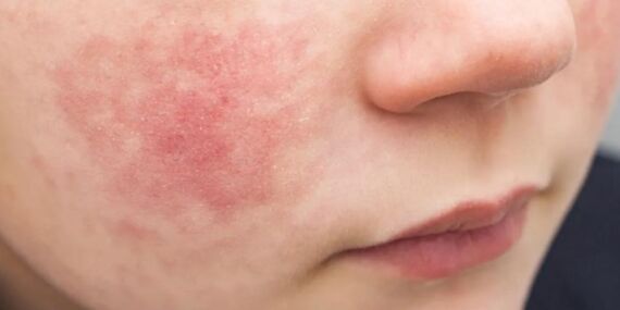 Parvovirüs B19 vakaları çoğalıyor: Sağlığınız için almanız gereken önlemler